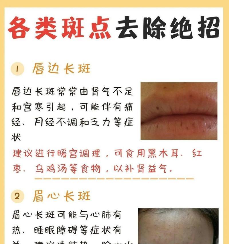 告别老年斑，拥有年轻肌肤（最有效的方法揭秘，老年斑消除神奇全攻略）